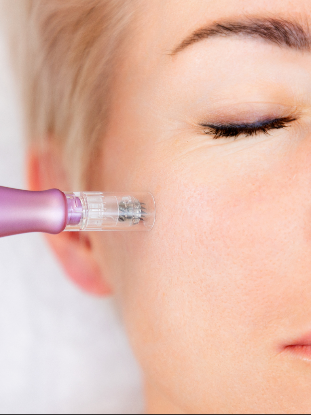 Microneedling | Microagujas ⭐️